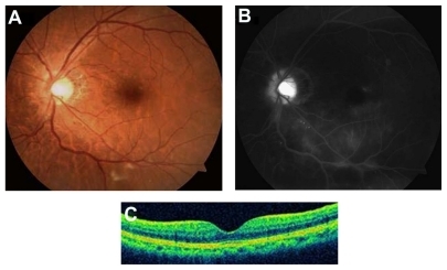 Figure 3 (A) Twelve months after treatment, the color fundus photograph shows a well-defined optic disc margin with resolution of peripapillary hemorrhage. (B) Fluorescein angiography demonstrates persistent decreased microangiopathy and vascular leakage. (C) Optical coherence tomography (OCT) reveals sustained resolution of serous retinal detachment.