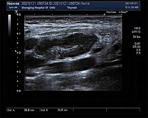 Figure 1 Ultrasonogram of lymph node.