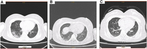 Figure 2 Computed tomography scan results of the patient’s mother’s lungs. (A) On January 23, 2020, computed tomography (CT) scan of the patient’s mother, a 40-year-old female, showed ground glass density shadow under the pleura of both lungs and the bilateral middle and lower lungs; (B) Chest CT examination on February 6, 2020 showed that the lung lesions were obviously absorbed; (C) CT scan images on February 24, 2020 showed that most of the multiple exudative foci in both lungs were absorbed and dissipated.