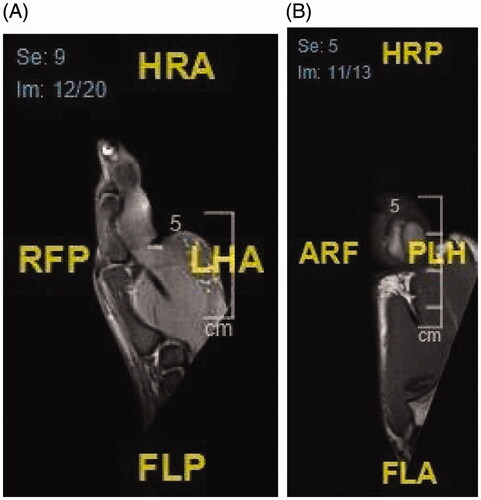 Figure 2. (A,B) The lipoma measures 2.2 × 2.8 × 4.3 cm in anteroposterior, transverse, and cranio-caudal diameters respectively.