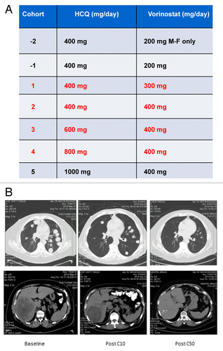 Figure 1. The combination of HCQ and vorinostat (VOR) induced a dramatic response in a patient with renal cell carcinoma (RCC). (A) Study dosing scheme. The dose of HCQ and VOR for each cohort are defined. Each cohort that was evaluated is indicated in red font. Patients were not enrolled in cohorts 1, 2 as dose de-escalation was not required. Enrollment in cohort 5 was not initiated based on dose-limiting toxicities (DLTs) that were observed in cohort 4. The dosing utilized for cohort 3 (600 mg HCQ + 400 mg VOR daily) was defined as the maximum tolerated dose (MTD). (B) Treatment with HCQ and VOR yielded a prolonged partial response in a patient with refractory RCC that has been durable for more than 50 cycles of therapy. MRI scans obtained at baseline and post cycles 10 and 50 (C10 and C50, respectively) are shown.