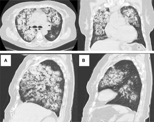 Figure 1 Chest computed tomography on admission showing bilateral opacities attributed to alveolar infiltrations as well as a few small cavitary lesions. (A) left lung, (B) right lung.