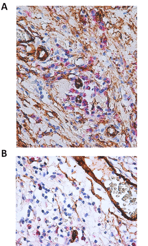 Figure 2. Basaloid oral cancer. COX-2 showed low level of expression in basaloid type OSCC together with very low level of neoangiogenesis and consequent tumor necrosis (LSAB-HRP, nuclear counterstaining with hematoxylin; original magnification x200).