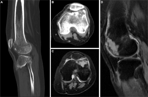 Figure 2 (A and B) CT shows the extent of bone destruction; (C and D) MRI shows the extent of the metastatic lesion.