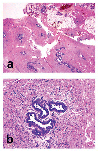 Figure 1 Histopathological findings. (A) Groups of proliferating and branching ductal structures embedded in a fibrous connective tissue stroma in the subcutaneous fat tissue (haematoxylin and eosin, original magnification x6.25). (B) Dilated ducts with intraluminal secretion are lined by cuboidal cells. The connective tissue stroma was sparse around the ducts (haematoxylin and eosin, original magnification x100).