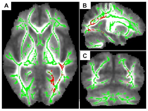 Figure 1 AD patients who developed delusions (n = 10) exhibited lower FA values than those who did not develop delusions (n = 15). To aid visualization, the regions with significant FA reductions (P < 0.05, corrected by TFCE) have been thickened (pink-red). The results (left inferior longitudinal fasciculus, left inferior fronto-occipital fasciculus, left posterior corona radiate, left forceps major of the corpus callosum) are shown overlaid on the mean FA map and the FA skeleton (green); (A) axial slice; (B) sagittal slice; (C) coronal slice.