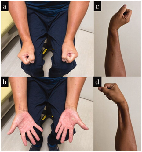 Figure 3. Final appearance and range of motion of case 1. (a–d) Appearance and range of motion at 1 year after the injury.