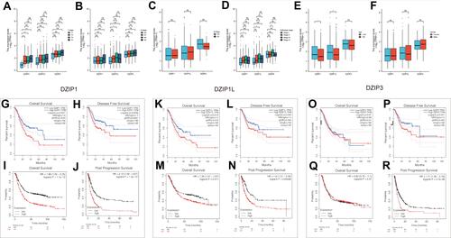 Figure 3 Association of DZIP expression with clinicopathological features in gastric cancer (GC). (A–F) Association of DZIP mRNA levels with T stage (tumor stage), N stage (nodal stage), M stage (metastatic stage), American Joint Committee on Cancer (AJCC) stage, age, and sex in GC patients. Kaplan–Meier survival curves comparing the high and low expression of DZIP1 in three probe sets from the Kaplan–Meier plotter database and Gene Expression Profiling Interactive Analysis (GEPIA) database. (G, K, O) Overall survival (OS), examined using the GEPIA database (n=384). (H, L, P) Disease-free survival (DFS), examined using the GEPIA database (n=384). (I, M, Q) OS, examined using the Kaplan–Meier plotter database (n=875). (J, N, R) Post-progression survival (PPS), examined using the Kaplan–Meier plotter database (n=498). *P < 0.05, ***P < 0.001.