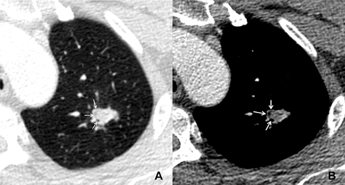 Figure 1 A patient with pulmonary cryptococcosis. (A and B) axial CT images show a solid nodule located in the left upper lobe, there is a crescent-shaped collection of air and lower density in the periphery of this nodule (air crescent sign) (arrows). (B) on enhanced CT image, the nodule shows ring-like enhancement.