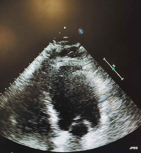 Figure 1. Transthoracic Echocardiogram showing diffuse apical hypokinesis.