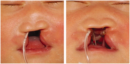 Figure 1. Median cleft lip and flatted nasal dome in a 7-days old girl with lobar-type-holoprosencephaly.