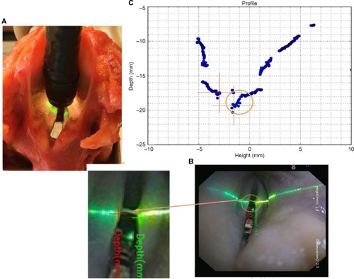 Figure 4 (A) Study setting showing the operative video-gastroscope introduced into the larynx vestibule with the laser beam “scanning” both vocal folds. (B) Endoscopic image of the laser beam “scanning” the glottis and the larynx vestibule; a zoomed image shows the respective positions of VF medial edges where VF height was measured from the tip of the video-endoscope (crosses represent medial free edges [green=right, red=left]; note the fortuitous presence of a secretion between the vocal folds at the level of the laser beam). (C) Larynx ruler screen capture showing the section profile by plotting heights measured from the tip of the video-endoscope, of every pixel that is illuminated along the laser beam. The orange circle in (C) corresponds to the orange circle in (B).