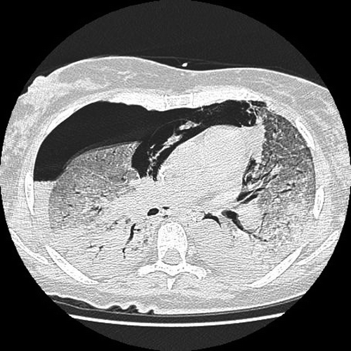 Figure 2. Chest CT scan 16 days after the fourth docetaxel course with severe interstitial pneumonitis, complicated by right-sided pneumothorax and pneumopericardium.