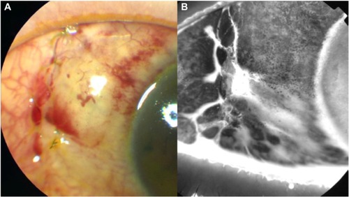 Figure 2 (A and B) Photographs obtained 2 days after the initiation of sodium hyaluronate eye drops.