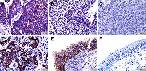 Figure 1 Expression of HSP10 and HSP70 in NPC and non-cancerous control nasopharyngeal epithelium was detected by IHC. The expression of HSP10 and HSP70 was detected by IHC using specific antibodies as described in “Materials and methods“ section. Strong positive granule expression of HSP10 protein was distributed in the cytoplasm of the NPC (A), weak expression of HSP10 protein was showed in the control nasopharyngeal epithelial cells (B), and there was negative staining of HSP10 in the NPC (C). Strong expression of HSP70 protein was located in the cytoplasm and nucleus of NPC (D), moderated positive staining of HSP70 was indicated in the cytoplasm and nucleus of nasopharyngeal epithelial cells (E), and there was no expression of HSP70 protein in the control nasopharyngeal epithelial cells (F) (IHC, 3,3ʹ-diaminobenzidine staining, original magnification ×200).Abbreviations: HSP, heat shock protein; NPC, nasopharyngeal carcinoma; IHC, immunohistochemistry.