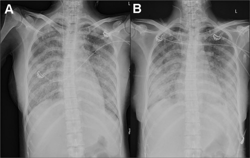 Figure 2 (A) A bedside chest X-ray revealed double-lung pneumonia, (B) extensive exudation in both lungs, with small nodules visible, especially in the lower lobes of both lungs.