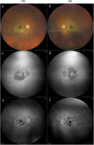 Figure 2. Widefield fundus photographs, fundus autofluorescence (FAF), and fluorescein angiography (FA) of patient with maternally inherited diabetes and deafness (MIDD)