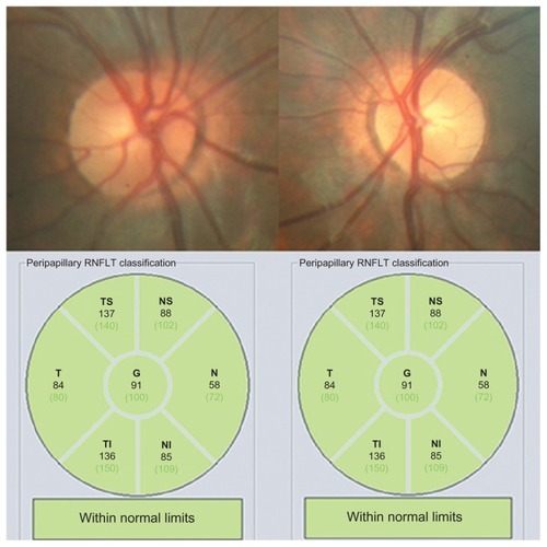 Figure 3 At the end of follow-up (4 months), a normal cup-to-disc ratio was seen in both eyes, and optical coherence tomography revealed a normal peripapillary retinal nerve fiber layer thickness.