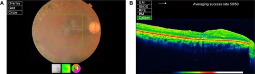 Figure 1 (A) The image of a GCC scan which is centered 1 mm temporal to the fovea and covered a square grid on the central macula. (B) The OCT image showing ILM, IS/OS, RPE, and BM. (C) The postoperative OCT image of a patient showing retinal nerve fiber layer, ILM and IS/OS, and optic nerve head parameters.
