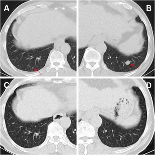 Figure 6 CT images before and after treatment. On admission before treatment, pulmonary metastasis (red arrow) were seen in the posterior segment of lower lobes of the lungs (A and B). After three cycles of treatments, the pulmonary metastasis had disappeared completely (C and D).