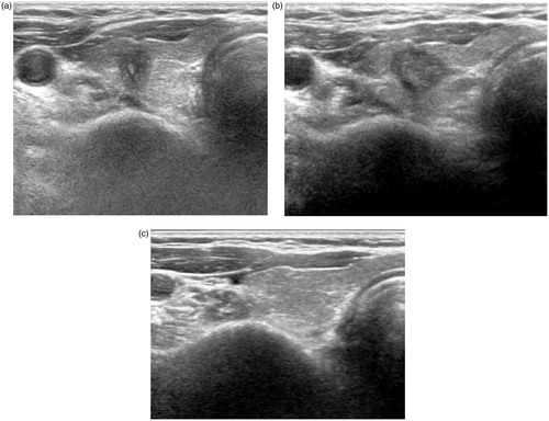 Figure 2. (A, B and C) Complete disappearance of papillary thyroid carcinoma after radiofrequency ablation. (A) Ultrasonography of a 64-year-old woman revealed a 10 mm mass proven as a papillary thyroid carcinoma on both fine-needle aspiration and core-needle biopsy in the right thyroid gland. (B) At 1-month follow-up after radiofrequency ablation, ultrasonography revealed a 12 mm ablation zone. (C) At 2-year follow-up, the ablation zone completely disappeared on ultrasonography.
