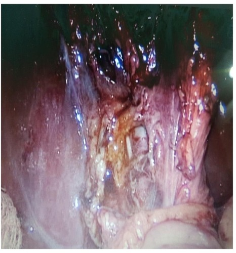 Figure 1 Site of injury to the ARHD after extraction of the gall bladder.