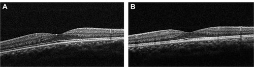 Figure 6 Case 2: optical coherence tomography showed that the foveal architecture was preserved in both eyes.