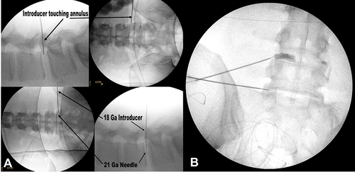 Figure 2 Injectable disc stabilization device (IDSD) delivery: fluoroscopic images. (A) Lateral and anterior–posterior images showing an 18 Ga introducer needle contacting the outer posterolateral annulus and a 21 Ga needle placed in the mid-lateral annulus; (B) contrast agent shows the device placement in the hemi-annulus following a posterolateral injection.
