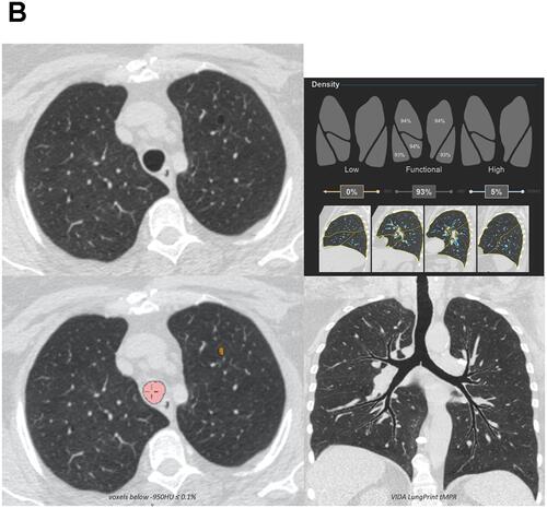 Figure 2 Examples of discordant assessments. (A) The computed tomography was visually interpreted as negative for emphysema but emphysema was identified quantitatively; axial multiplanar reformat (MPR) (upper left), low attenuation area (LAA) percentages by lung lobe (upper right), axial MPR with LAA overlay (lower left), and topographic MPR (lower right) provided. Quantitative measures correlated with spirometry in this participant. (B) Visual-only identified emphysema. Small areas identified quantitatively but were not above the LAA ≤950 Hounsfield units 5% threshold; axial MPR (upper left), LAA percentages by lung lobe (upper right), axial MPR with LAA overlay (lower left), and topographic MPR (lower right) provided. Quantitative measures also correlated with spirometry. Images courtesy of VIDA, Coralville, Iowa, USA.