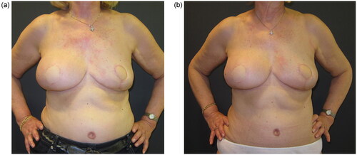 Figure 4. Post-operative result at 10-month follow-up after the left breast reconstruction, when additional lipofilling was Decided for better symmetry between the two reconstructed breasts (a); final post-operative result at 20-month follow-up after the second lipofilling session (b).