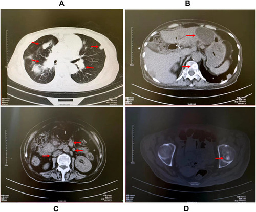 Figure 2 Computed tomography (CT) scan of the chest and abdomen. Multiple metastases of the tumor were observed in the lung (A), liver, vertebral body (B), retroperitoneum (C), and caput femoris (D).