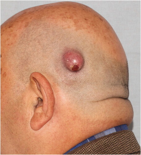 Figure 4. Mobile, hyperemic tumor located in the left temporal region.
