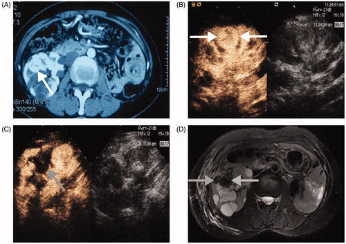 Figure 2. A 3.3 × 3.0 cm tumour in the solitary kidney of a 48-year-old woman treated with MWA. (A) Preablation enhanced-CT image shows the lesion adjacent to the renal pelvis (white arrow); (B) CEUS displays a heterogeneous hyperenhancement neoplasm (white arrow); (C) CEUS shows no hyperenhancement in the ablation zone (grey arrow) three days after MWA; (D) After MWA, a MR Image shows no residual tumour in the ablation zone (grey arrow).