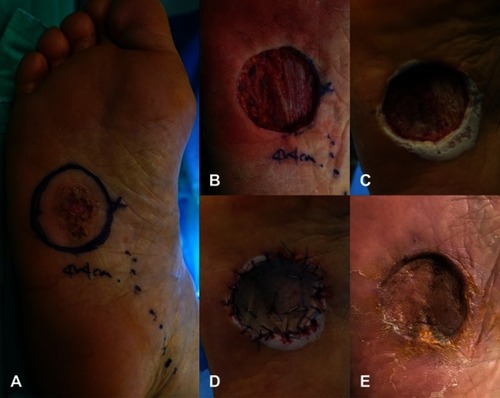 Figure 1 A 66-year-old woman visited our hospital due to chronic ulceration of the right foot 8 months ago. (A) There was a 3×2 cm erythematous reticular chronic ulcer lesion in the mid-plantar surface of the foot. (B) Wide excision with a margin of 1 cm or more was performed. Plantar fascia and lateral plantar neurovascular bundle were exposed through skin defect. (C) One week after the operation, a dermal matrix was formed by granulation in the skin defect. (D) Split-thickness skin graft was performed by harvesting from the ipsilateral thigh. (E) After 8 weeks postsurgery, complete healing of the skin graft was confirmed.