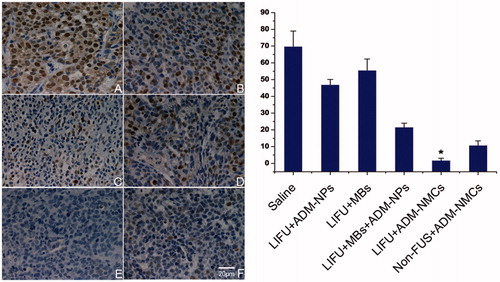 Figure 6. The left panel shows the expression of PCNA in tumor using immunohistochemical staining after each treatment. Less PCNA-positive cells were seen in group E when compared to the other groups (*p < 0.05). (A) Control group; (B) ADM-NPs + LIFU; (C) MBs + LIFU; (D) ADM-NPs + MBs + LIFU; (E) ADM-NMCs + LIFU; (F) ADM-NMCs + non-FUS. The right panel shows the proliferation index (PI) of tumor tissue in each group (*p < 0.05).