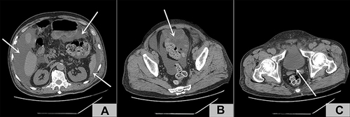 Figure 2 (A) A large amount of effusion in the abdomen (white arrow); (B) Suspected bladder breach (white arrow); (C) The median lobe of the prostate was not protruded into the bladder (white arrow).