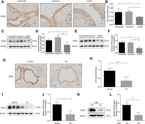 Figure 3 GPX4 expression is downregulated in the lungs of COPD patients, murine models and CSE-treated HBE cells. (A) GPX4 immunostaining of lungs from Control-NS, Control-S and COPD patients is shown (original magnification ×400). Bar: 50 μm. The results were scored by (B) IOD/area. (CandD) Western blots of human lung homogenates from Control-NS, Control-S and COPD patients were probed using an anti-GPX4 antibody and normalized to β-actin levels (loading control). (E and F) Western blots of primary bronchial epithelial cells from Control-NS, Control-S and COPD patients were probed using an anti-GPX4 antibody and normalized to β-actin (loading control). (G–J) C57BL6 mice were exposed to room air (Control) or cigarette smoke (CS) for 6 months. (G and H) IHC staining of GPX4 in lungs from room air (Control)- and CS-exposed mice. Original magnification ×400. Bar: 50 μm. The results were scored by (H) IOD/area. (I and J) The expression levels of GPX4 in lung homogenates of room air (Control)- and CS-exposed mice were measured by Western blot analysis and normalized to those of β-actin. (K and L) The protein level of GPX4 in HBE cells treated with 0% or 5% CSE for 72 h was measured by Western blot and normalized to β-actin levels (loading control). The results are presented as the means ± S.E.M. from three independent experiments. *P<0.05; **P < 0.01; ***P < 0.001, ****P < 0.0001.