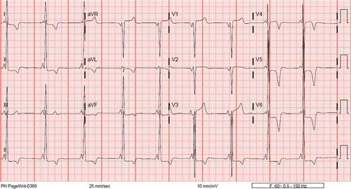 Figure 1. ECG of 46-year-old woman with apical hypertrophic cardiomyopathy, which revealed LVH pattern with diffuse T wave inversions.
