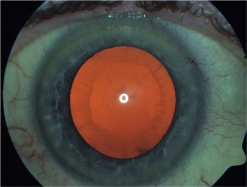Figure 1 Photograph showing the right eye of a patient included in the study suffering from exfoliative glaucoma.