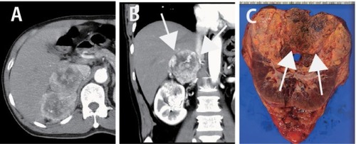 Figure 2 Computed tomography (CT) findings (A and B) and resected specimen (C) in Patient 2.