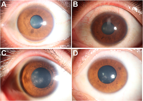 Figure 2 Slit lamp examination of the involved eyes at the last follow-up visit. (A) patient 1, 1 week after treatment; (B) patient 2, 2 weeks after treatment; (C) patient 3, 2 months after treatment; (D) patient 4, 1 week after treatment.