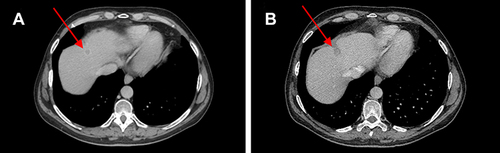 Figure 2 (A) Red arrows show liver metastases at baseline and (B) after 12 weeks of therapy with ribociclib.