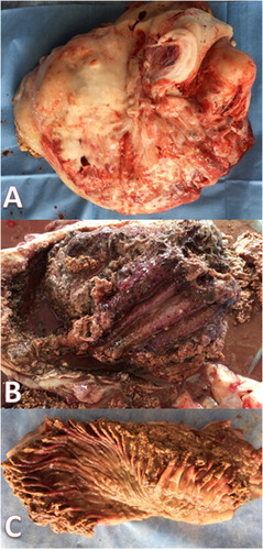 Figure 2. Abdominal enlarged hard mass weighting 10.5 kg (A). The cut section of the mass showing the abomasal (B) and omasal (C) folds were thickened, congested and ulcerated.