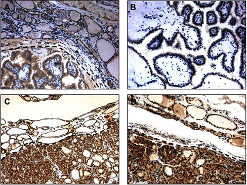 Figure 1 (A–D) PDCD4 immunohistochemistry in PTC samples. The neoplastic cells show low-grade nuclear PDCD4 expression (score 0: no stain and score 1: ≥1–≤30% positive nuclei), while normal tissue (above the line) expresses PDCD4 both in the nucleus and cytoplasm (A). Low-grade nuclear PDCD4 expression in PTC papillae at higher magnification (B). PTC sample with adjacent healthy tissue (above the line) and positive for PDCD4 expression. Both neoplastic cells both healthy cells show a high-grade nuclear PDCD4 staining (score 2: >30≤70%; score 3: ≥71%) (C), also confirmed at higher magnification (D). ×10 (A and C); × 20 (B and D) magnifications.Abbreviations: PDCD4, programmed cell death 4; PTC, papillary thyroid cancer.