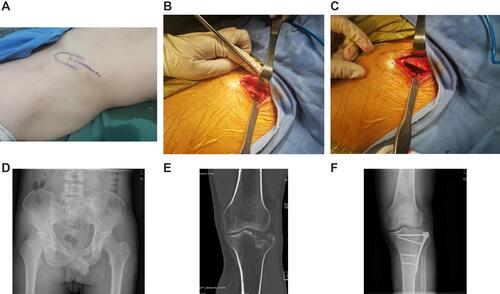 Figure 1 (A–F) depicts a 45-year-old male patient who was administered general anaesthesia before undergoing open reduction, internal fixation, and bone graft for the treatment of his left tibial plateau fracture. During the surgery, trapdoor-procedure-based bone harvesting was used. (A) illustrates the location of the bone harvesting site prior to surgery. (B) displays the site after the trapdoor was opened. (C) depicts the site when the trapdoor was placed back to the iliac spine. (D) represents a post-operative image of the pelvis. (E) illustrates a clear left tibial plateau fracture and articular surface collapse. (F) illustrates a post-operative left tibial plateau.