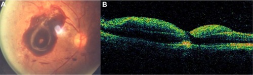 Figure 31 (A and B) Subhyaloid hemorrhage absorbs and reflects much of the Stratus optical coherence tomography light and hence, creates a large shadow obscuring the underlying structures.