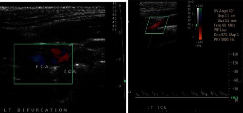 Figure 2 Doppler imaging of carotid artery dissection.