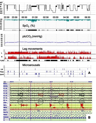 Figure 3 Periodic limb movements in sleep in a 62-year-old, non-ventilated patient with spinal onset ALS. (A) A polysomnography synopsis including hypnogram, oxygen saturation, transcutaneous ptcCO2, and graphical presentation of both leg movements (LM), and (micro)arousals from sleep (from top to bottom). Whereas capnometry is normal throughout the night, isolated obstructive sleep apnea is present leading to persistent desaturations (AHI 39.8/h). Almost permanent leg movements can be seen in both legs with long-lasting periodicity as reflected by the black bars within the fourth panel from above (PLMS). The PLM index was 117.1/h. However, only few PLM were associated with arousals from sleep, resulting in a PLM arousal index of no more than 5.4/h. (B) A 2-min excerpt from the same polysomnography with the timepoint according to the vertical black line in (A). Sleep stage is N2, and sleep-disordered breathing is absent. Only one of the 8 PLM which can be seen in the electromyography tracings (TIB L and TIB R, respectively) relates with an EEG arousal.