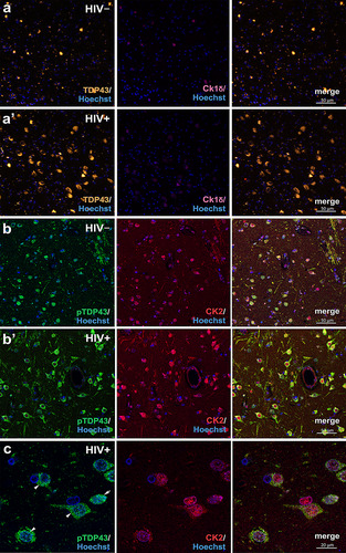 Figure 1 Pathologic deposition of TDP-43 and casein kinase 2 (CK2) immunoreactivity in the basal ganglia of HIV+   individuals. (a,a’ and b,b’) Representative confocal images of TDP-43, casein kinase 1δ (CK1δ), pTDP-43, and CK2 immunofluorescence in HIV− (a,b) and HIV+   (a’,b’) basal ganglia. Note the overall paucity of CK1δ antigenicity and the increased nuclear-to-cytoplasmic redistribution of TDP-43 antigenicity in the neural cells of HIV+   individuals. (c) A high magnification (63×) image showing pTDP-43 and CK2 immunofluorescence colocalization in cells within post-mortem HIV+   basal ganglia.