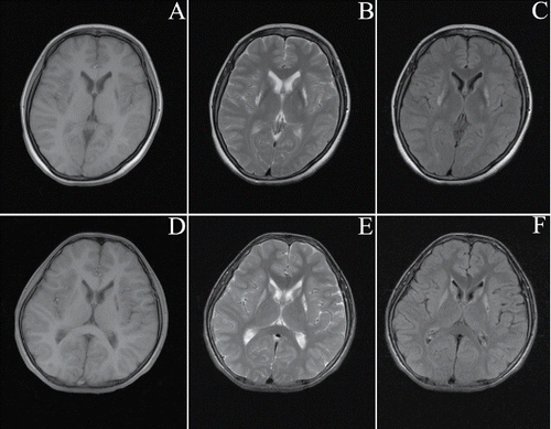FIGURE 1. Brain MRI of a patient with Wilson's disease. A, D: T1WI reveals a symmetric low signal in the bilateral basal ganglia; B, E: T2WI reveals a symmetric high signal in the bilateral basal ganglia; C, F: Axial fluid attenuated inversion recovery (FLAIR) MRI reveals a symmetric high signal in the bilateral basal ganglia.